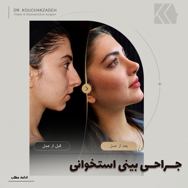 جراحی بینی استخوانی؛بهترین مدل عمل بینی استخوانی + نمونه کار قبل و بعد