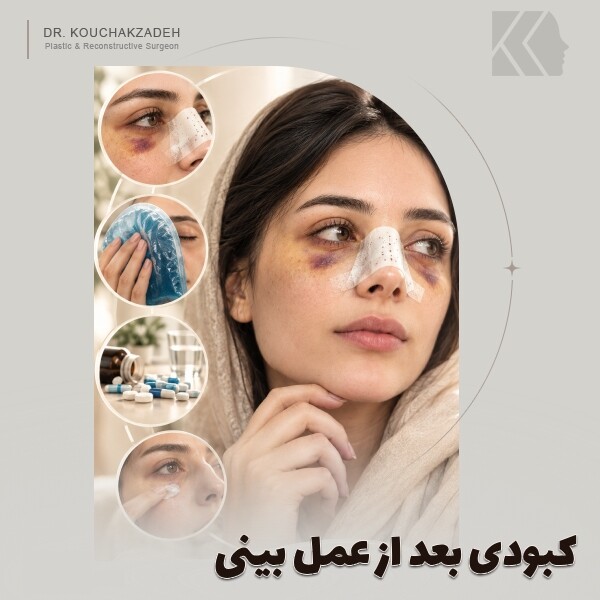 کبودی بعد از عمل بینی؛علت و راهکارهای درمان کبودی بعد از جراحی بینی