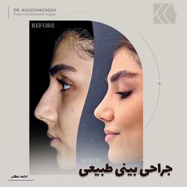 عمل بینی طبیعی و نچرال