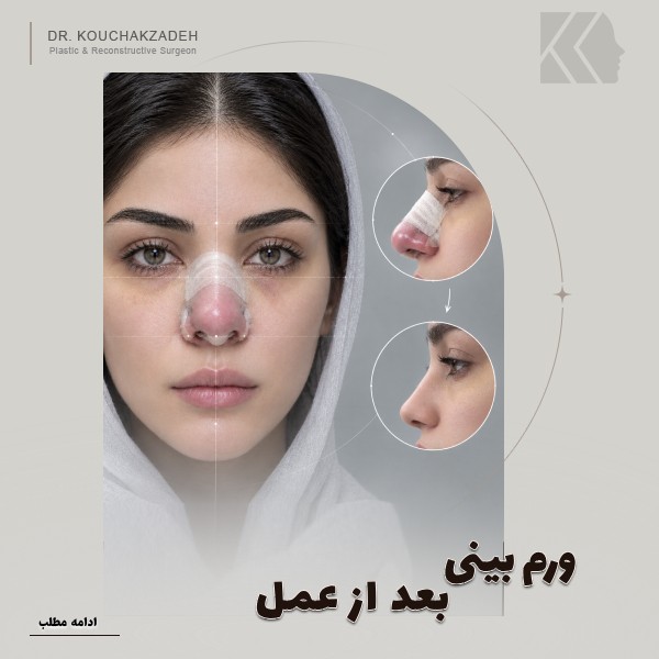 ورم بینی بعد از عمل